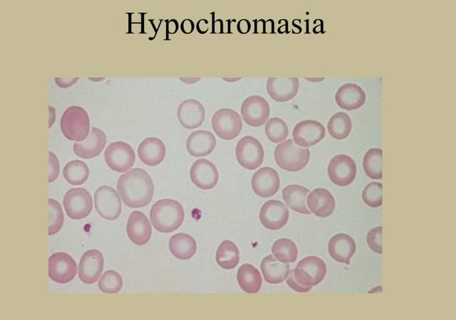 Hypochromasia