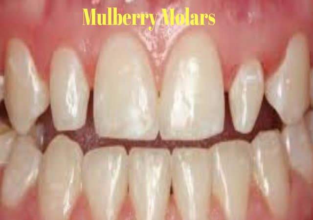 mulberry molars